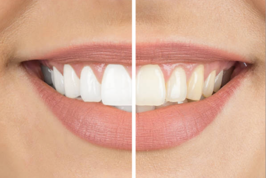 Teeth Whitening Course With Starter Kit