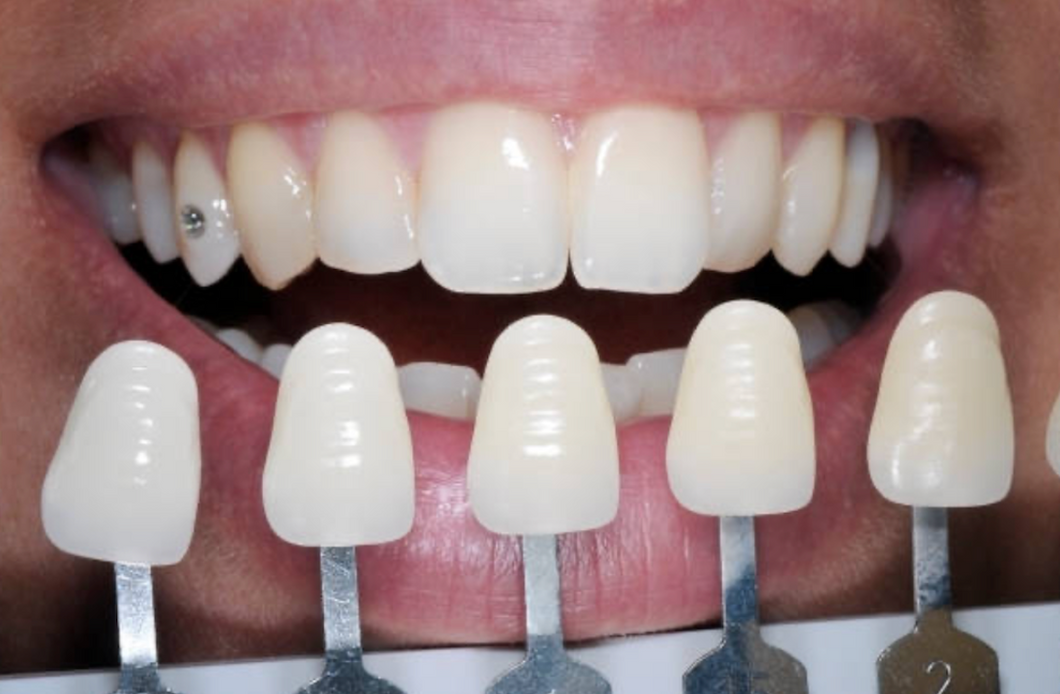 Combined Teeth Whitening & Tooth Gems Course WIth Starter Kit